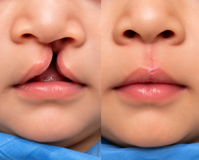 Surgeon consulting a patient about Congenital Lip Deformity Correction